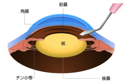 白内障