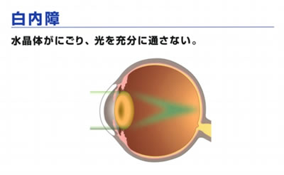 白内障