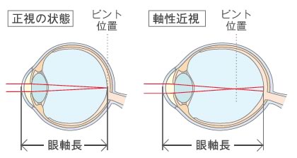 軸性近視